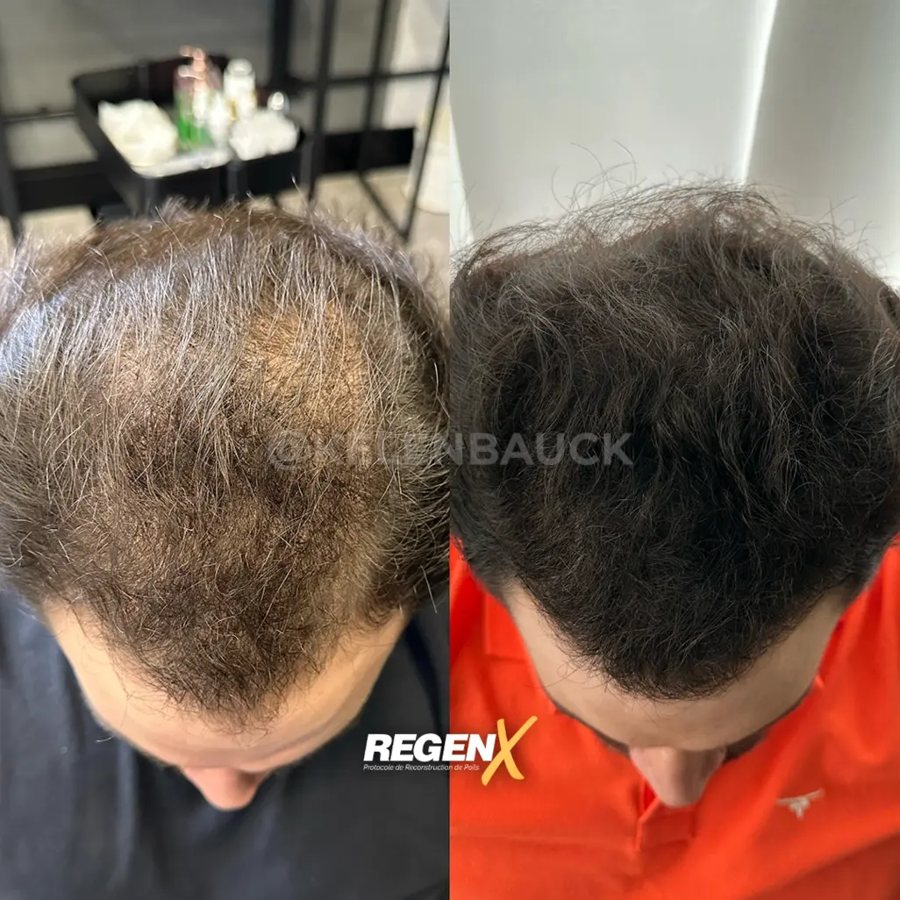 RegenX© cuir chevelu masculin, avant et après