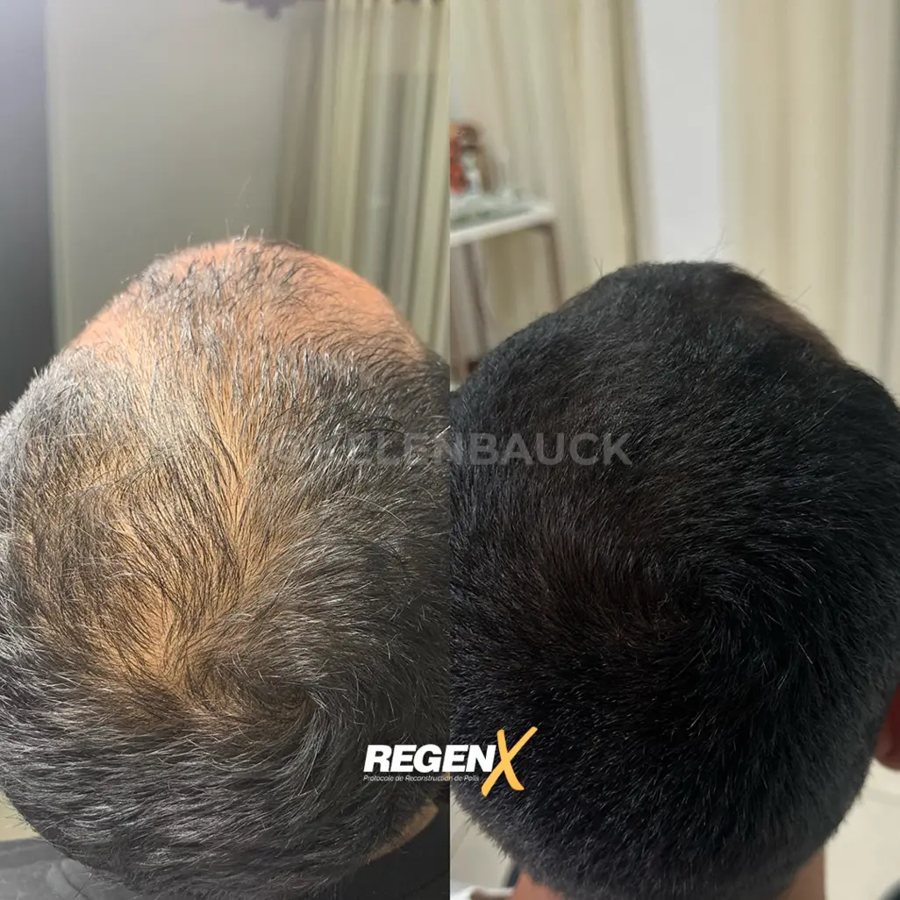 RegenX© cuir chevelu masculin, avant et après
